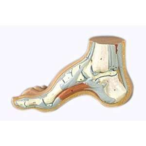  Hollow Foot   Pes Cavus