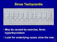   page EKG BASICS Electrocardiogram PowerPoint Presentation on CD  