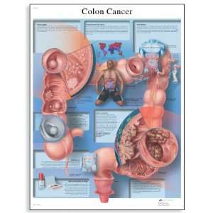3B Scientific VR1432L Glossy Laminated Paper Colon Cancer Anatomical 