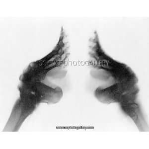  Bound feet of Chinese girl, X ray Framed Prints